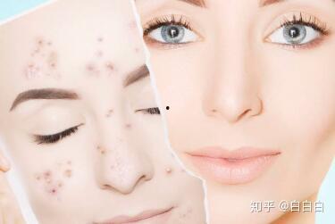 起痘可以吃瓜吗,起痘期间吃瓜的注意事项