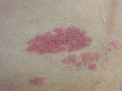 阑尾疼可以吃瓜吗,西瓜，甜蜜的禁忌？