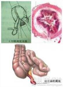 阑尾疼可以吃瓜吗,西瓜，甜蜜的禁忌？